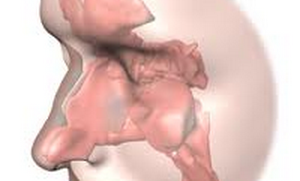 Photo of Cochlear Implant