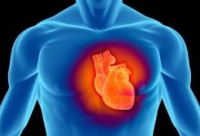 Photo of Angioplasty