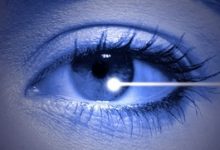 Photo of Corneal Transplantation